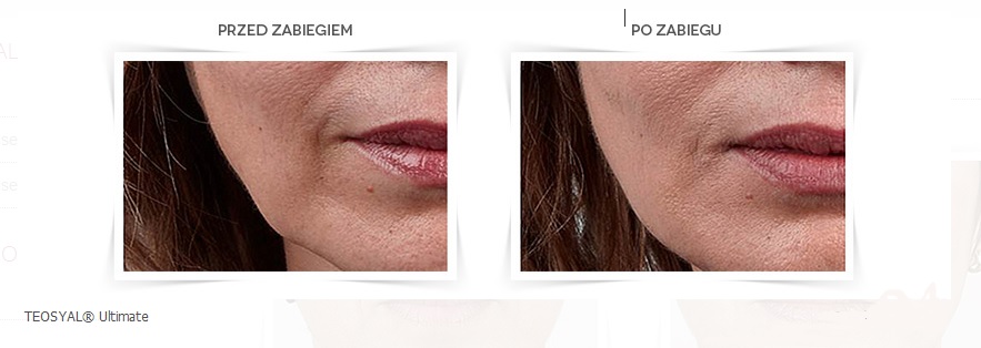 Teosyal Ultimate przed_po